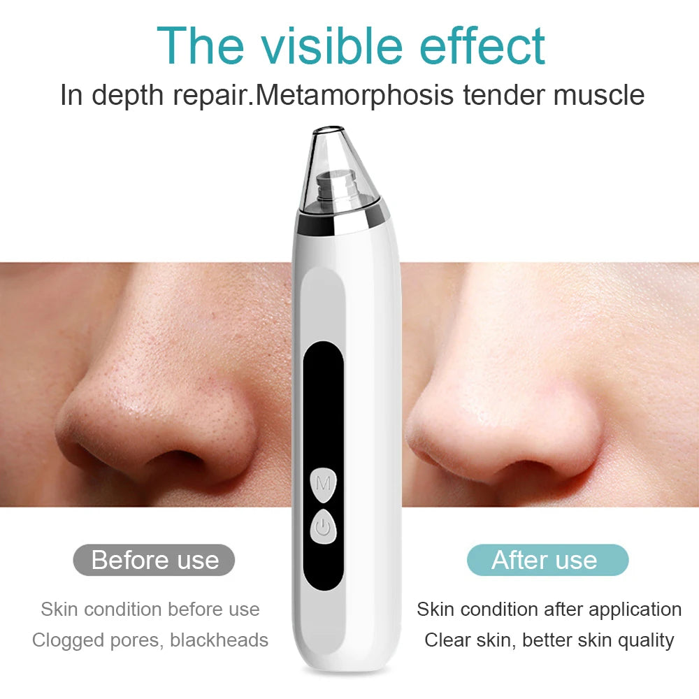 Facial and Nasal Pore Cleaner — Vacuum Blackhead Remover