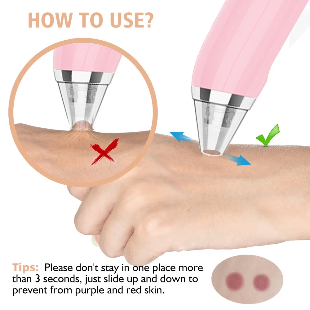 Facial and Nasal Pore Cleaner — Vacuum Blackhead Remover